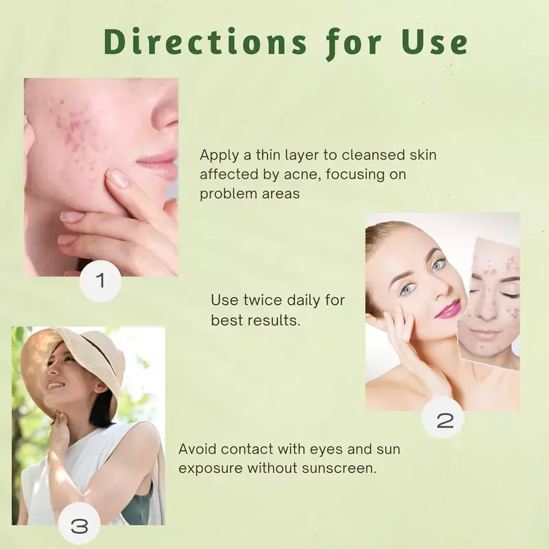 nti Acne Face Cream – 50 gms - photo 6