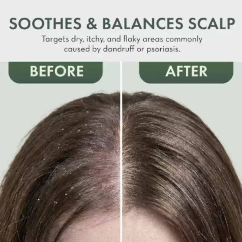 Anti Dandruff Hair Oil – 100 ml - photo 4